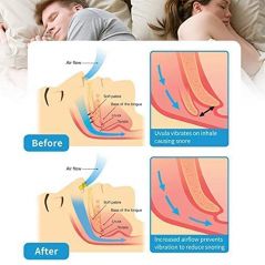 Anti Snoring Devices