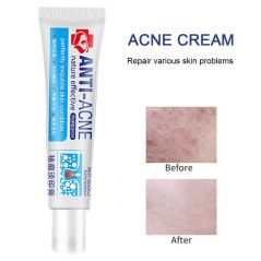 Crème anti-acné efficace, élimine les imperfections, les boutons, les taches, en toute sécurité, douce, pour éliminer l'acné sévère, nouvelle collection